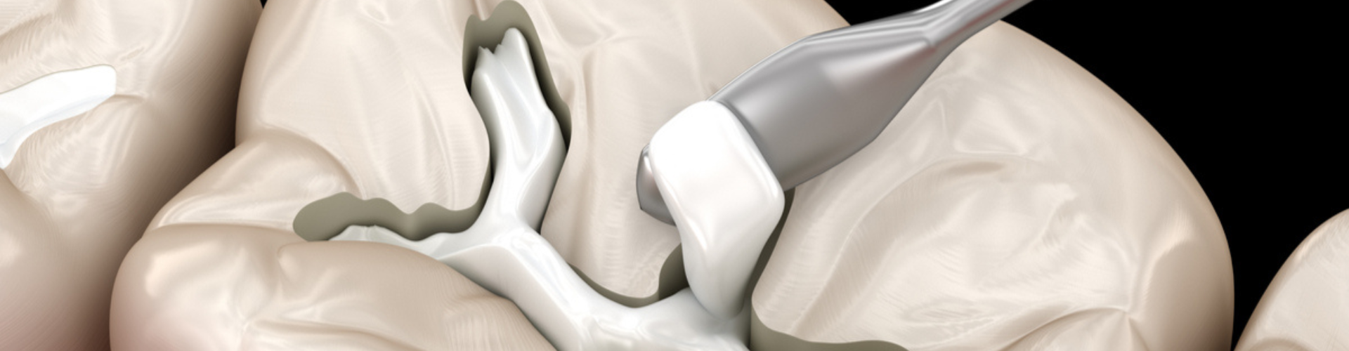 3D image of a tooth with dental fillings.